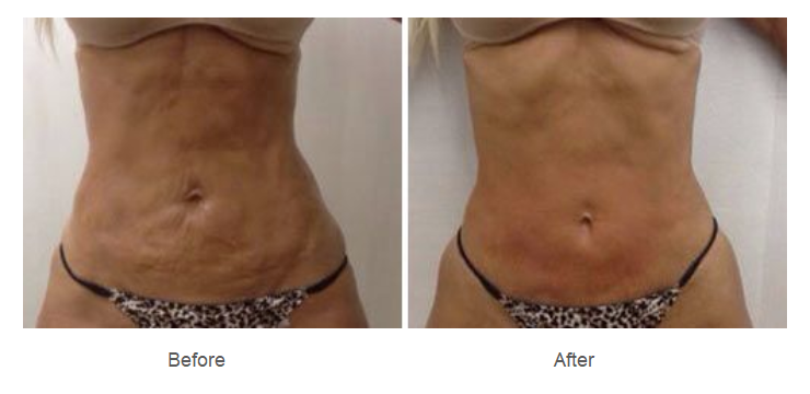 fotona tightsculpting near me